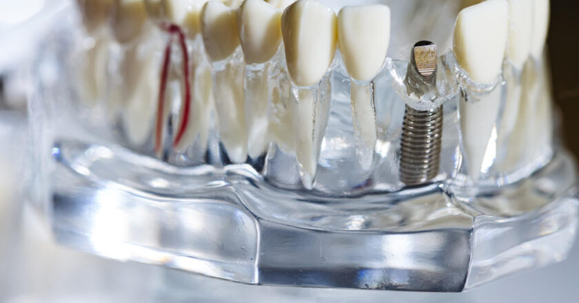 Trwałość i pewność na lata – implant zęba